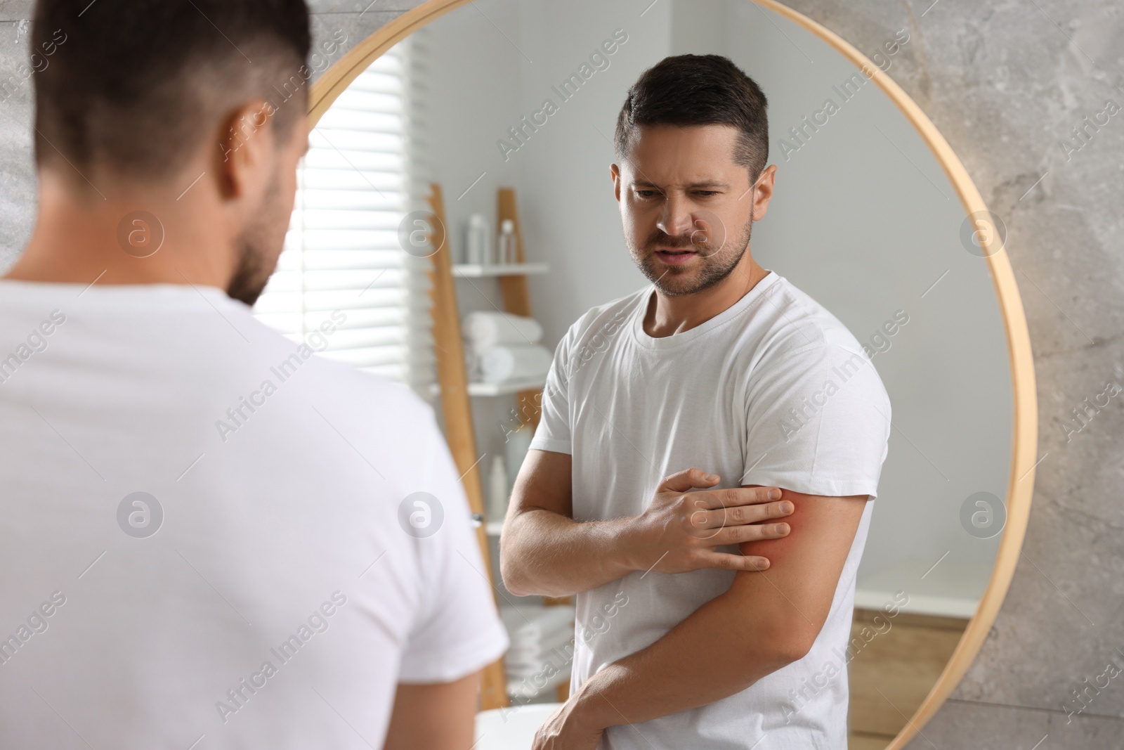 Photo of Man suffering from allergy looking at his arm in mirror indoors