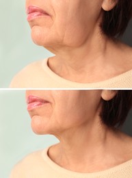 Image of Double chin problem. Collage with photos of mature woman before and after skin tightening treatments on light grey background, closeup