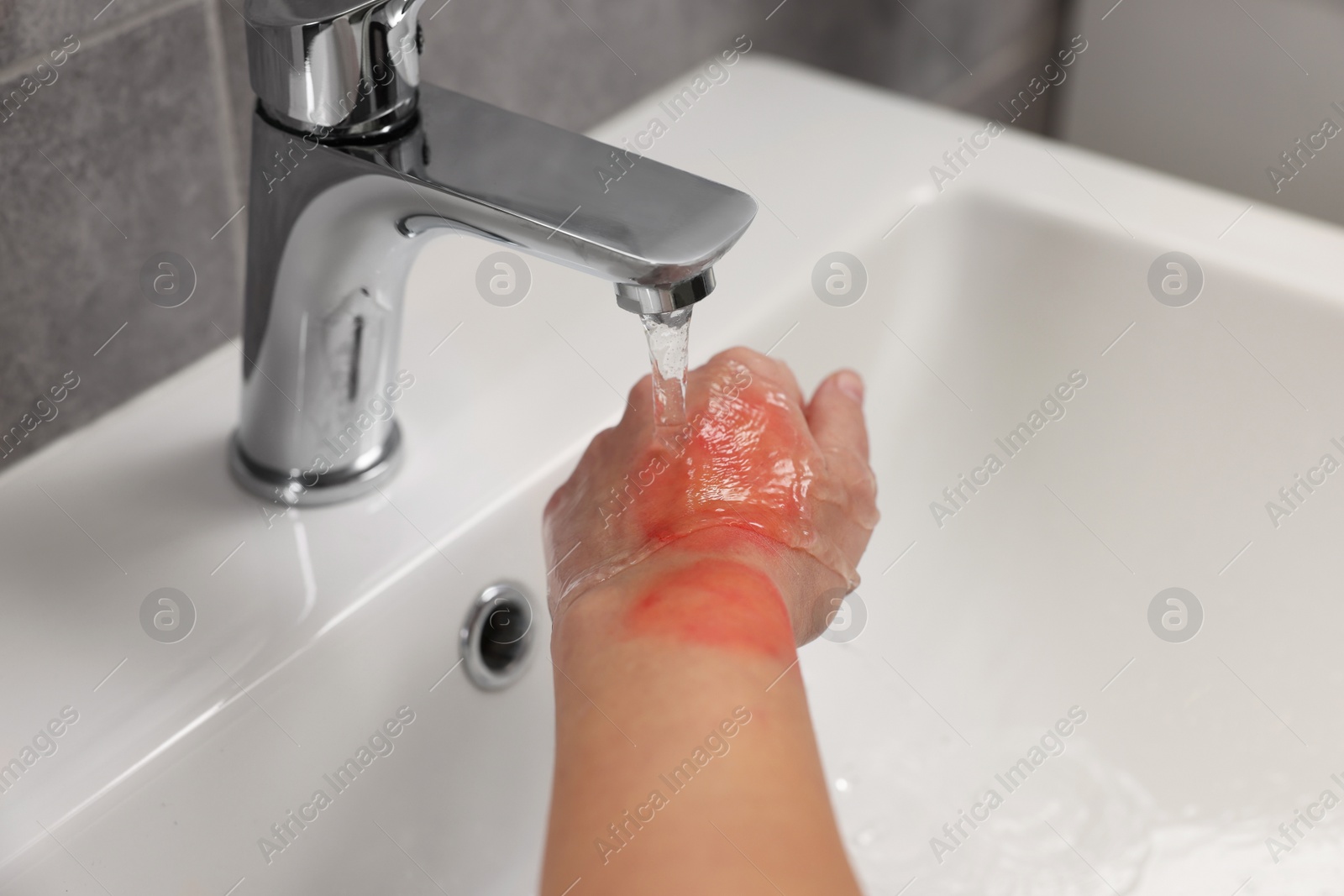 Photo of Woman holding burned hand under cold water indoors, closeup