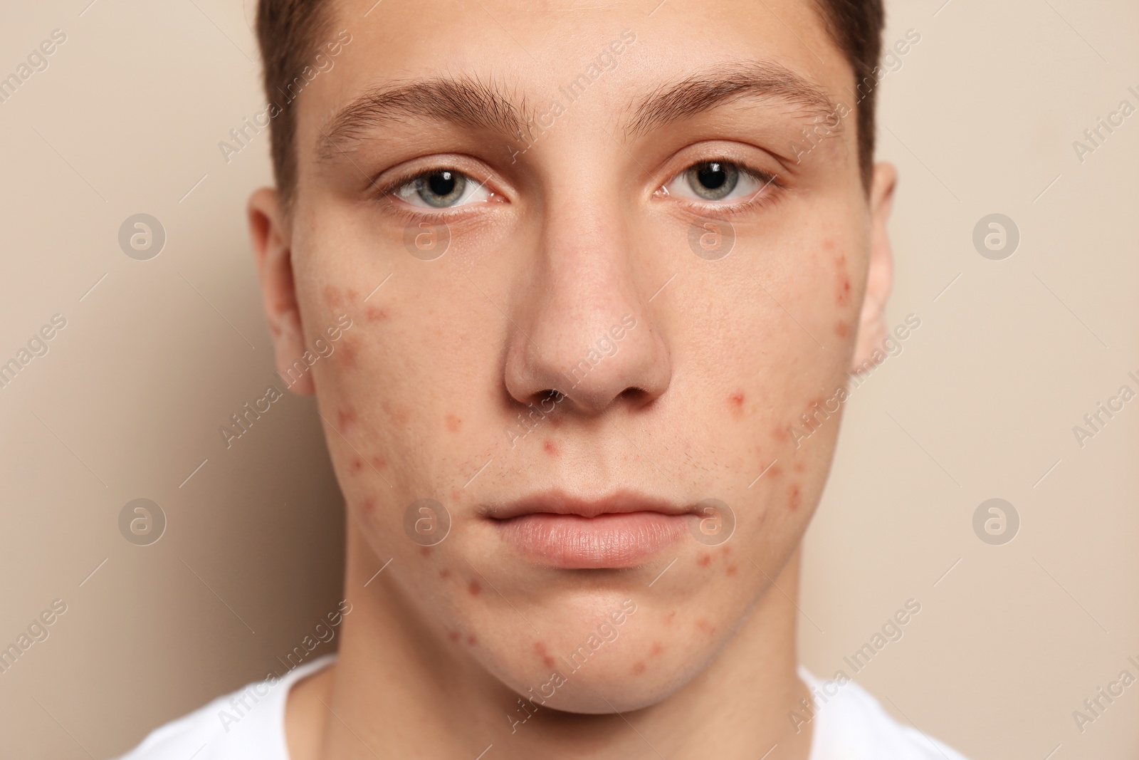 Photo of Teen guy with acne problem on beige background, closeup