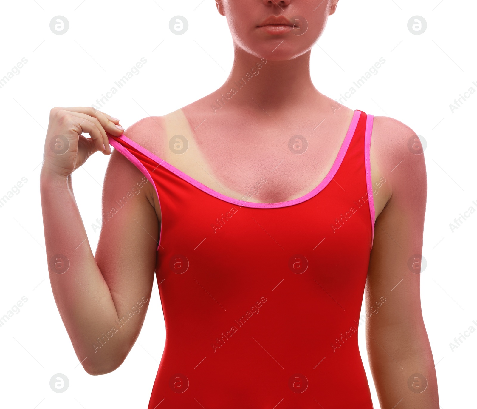 Photo of Woman with sunburned skin on white background, closeup