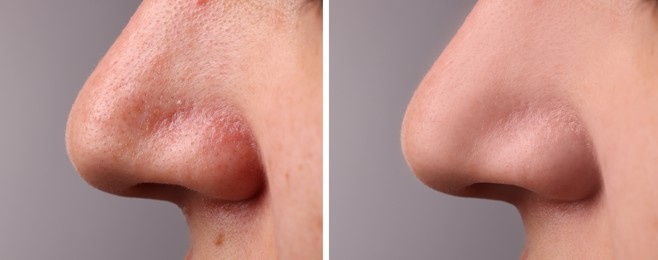 Before and after acne treatment. Photos of woman on grey background, closeup. Collage showing affected and healthy skin