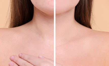 Image of Aging skin changes. Woman showing neck before and after rejuvenation, closeup. Collage comparing skin condition