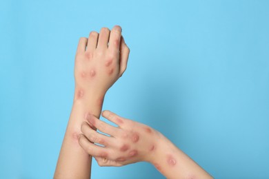 Woman with rash suffering from monkeypox virus on light blue background, closeup. Space for text