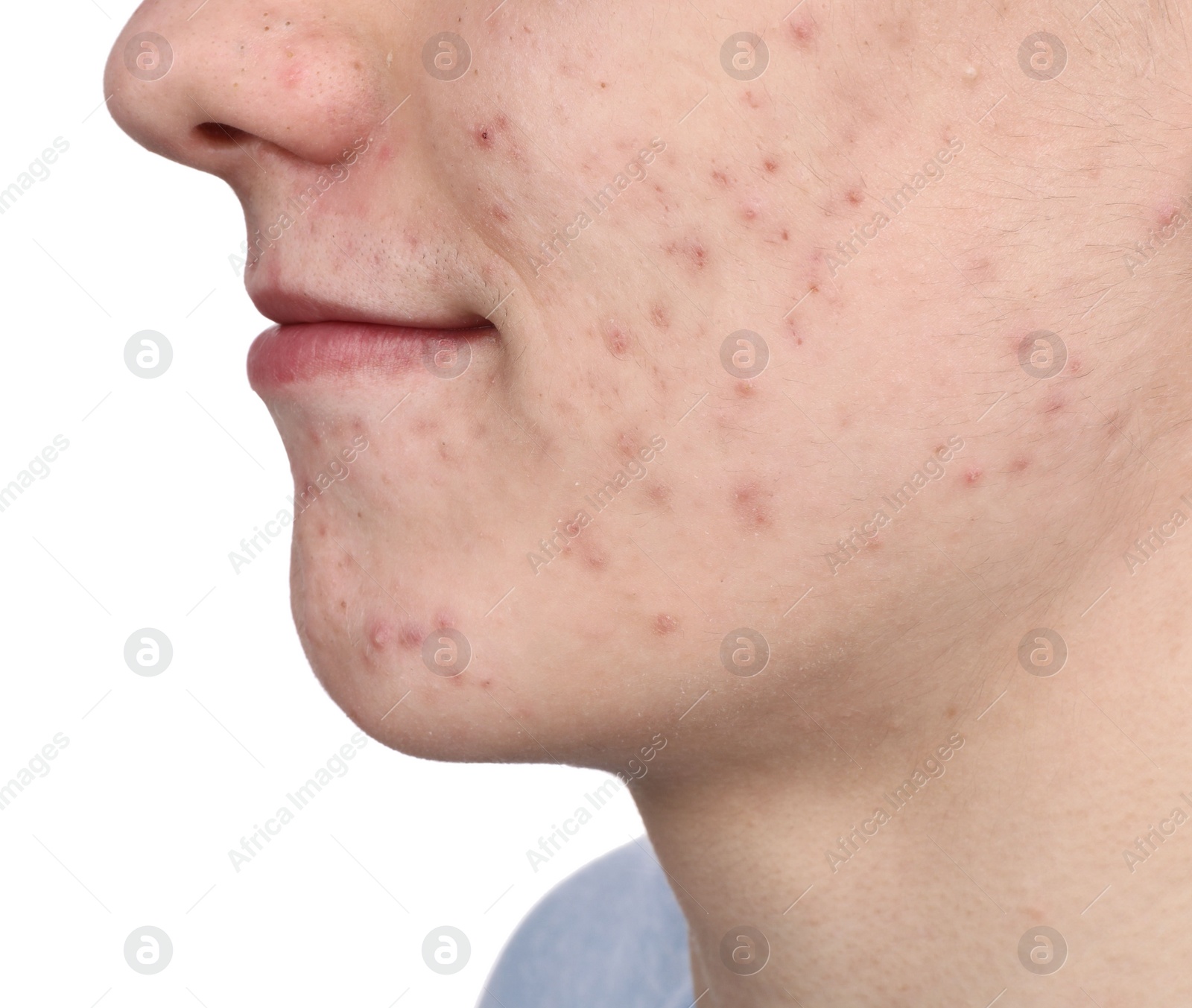 Photo of Young man with acne problem isolated on white, closeup