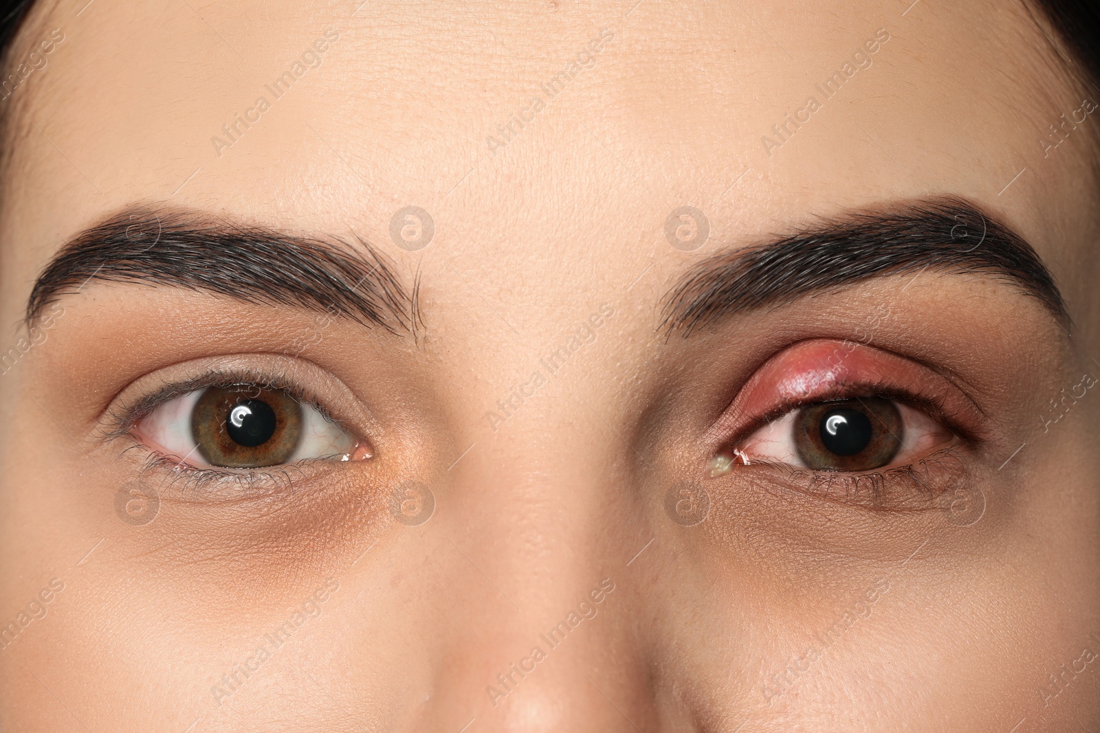 Image of Woman with inflamed eye suffering from conjunctivitis, closeup