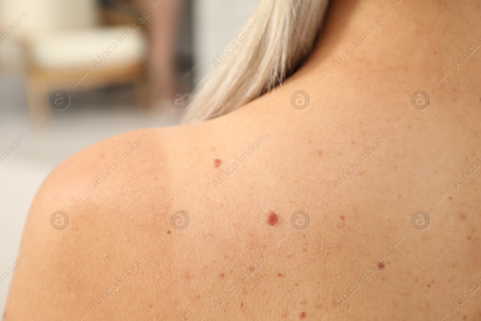 Photo of Closeup of woman`s body with birthmarks indoors, back view