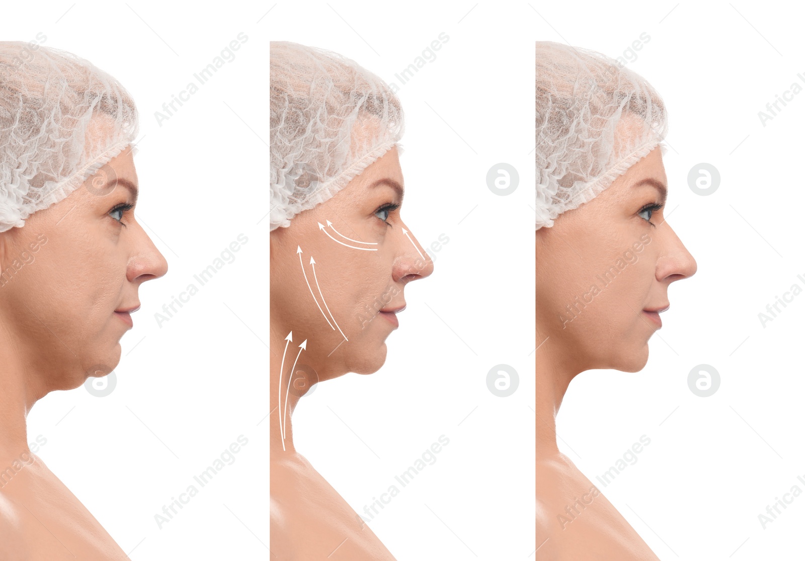 Image of Mature woman before and after plastic surgery operation on white background. Double chin problem 