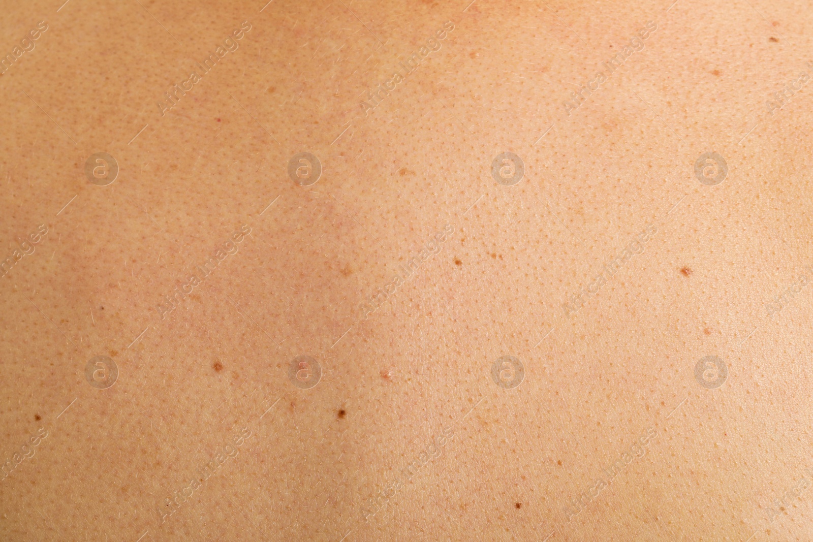 Photo of Texture of human skin with birthmarks, closeup view