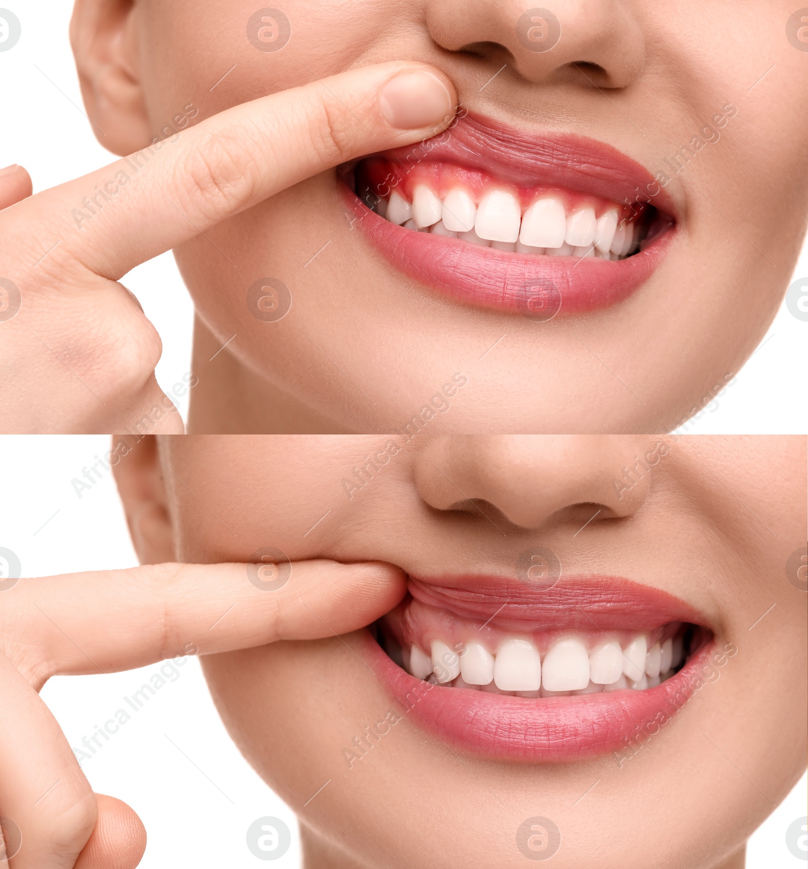 Image of Woman showing gum before and after treatment on white background, collage of photos