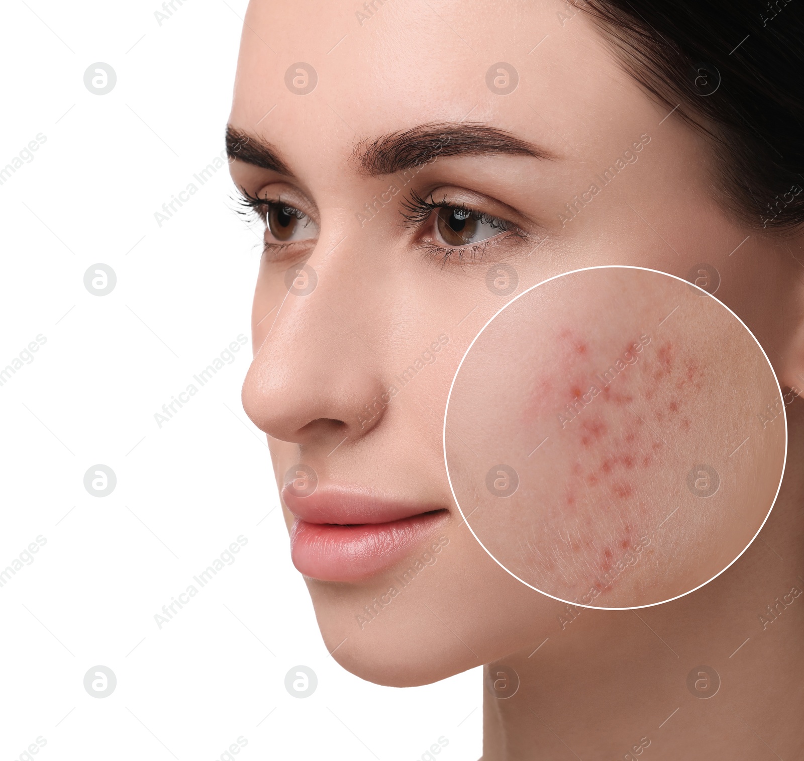 Image of Woman with acne on her face on white background. Zoomed area showing problem skin