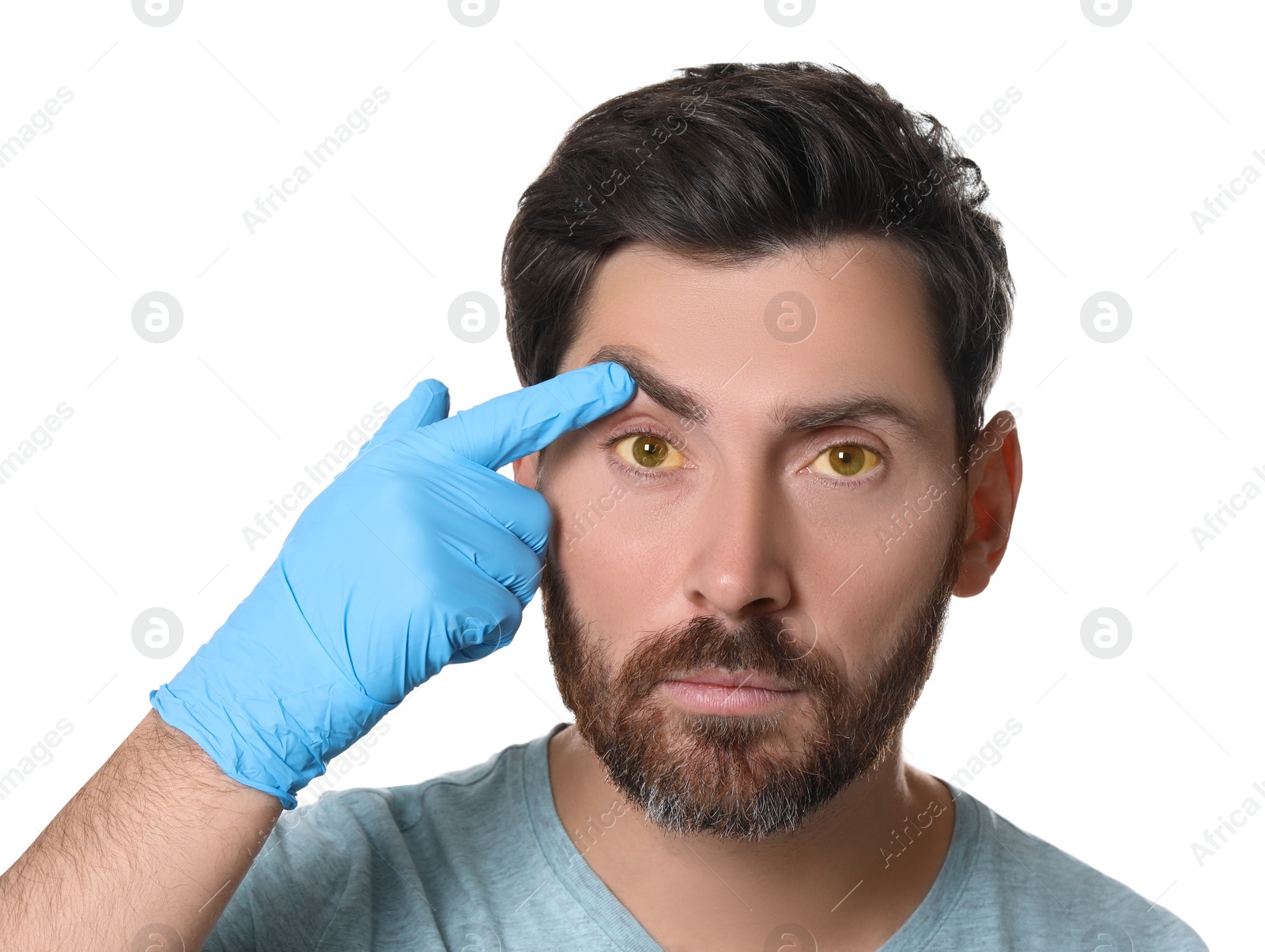 Photo of Doctor checking man with yellow eyes on white background. Symptom of hepatitis