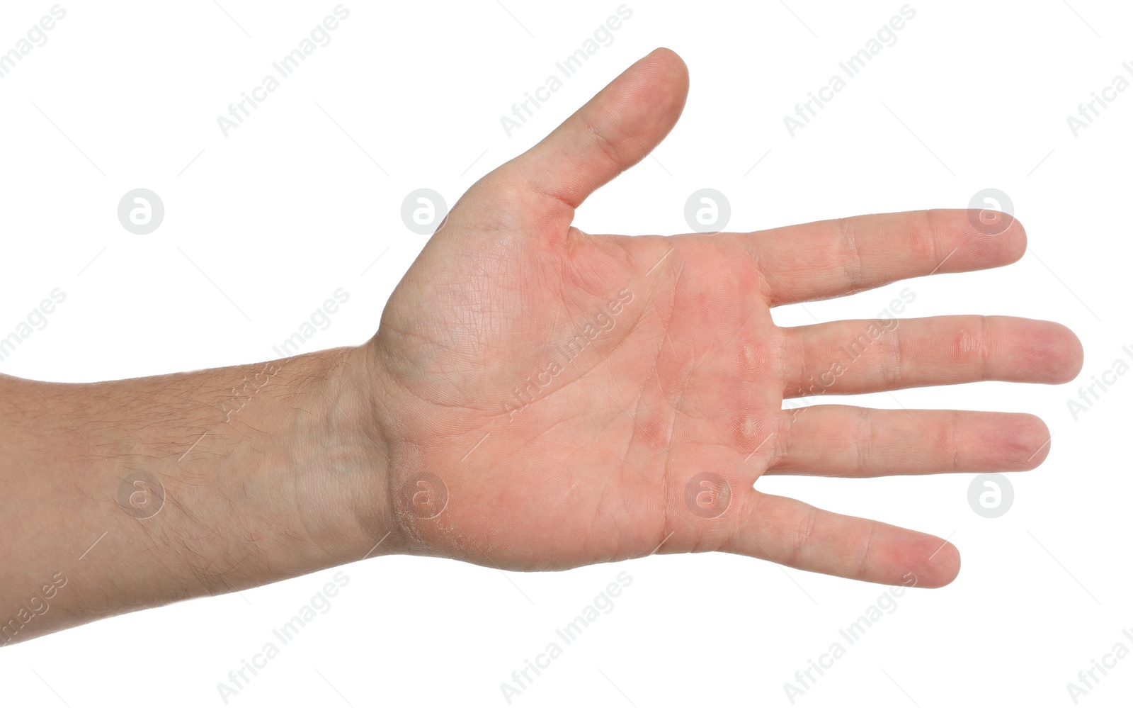 Photo of Man suffering from calluses on hand against white background, closeup