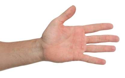 Photo of Man suffering from calluses on hand against white background, closeup