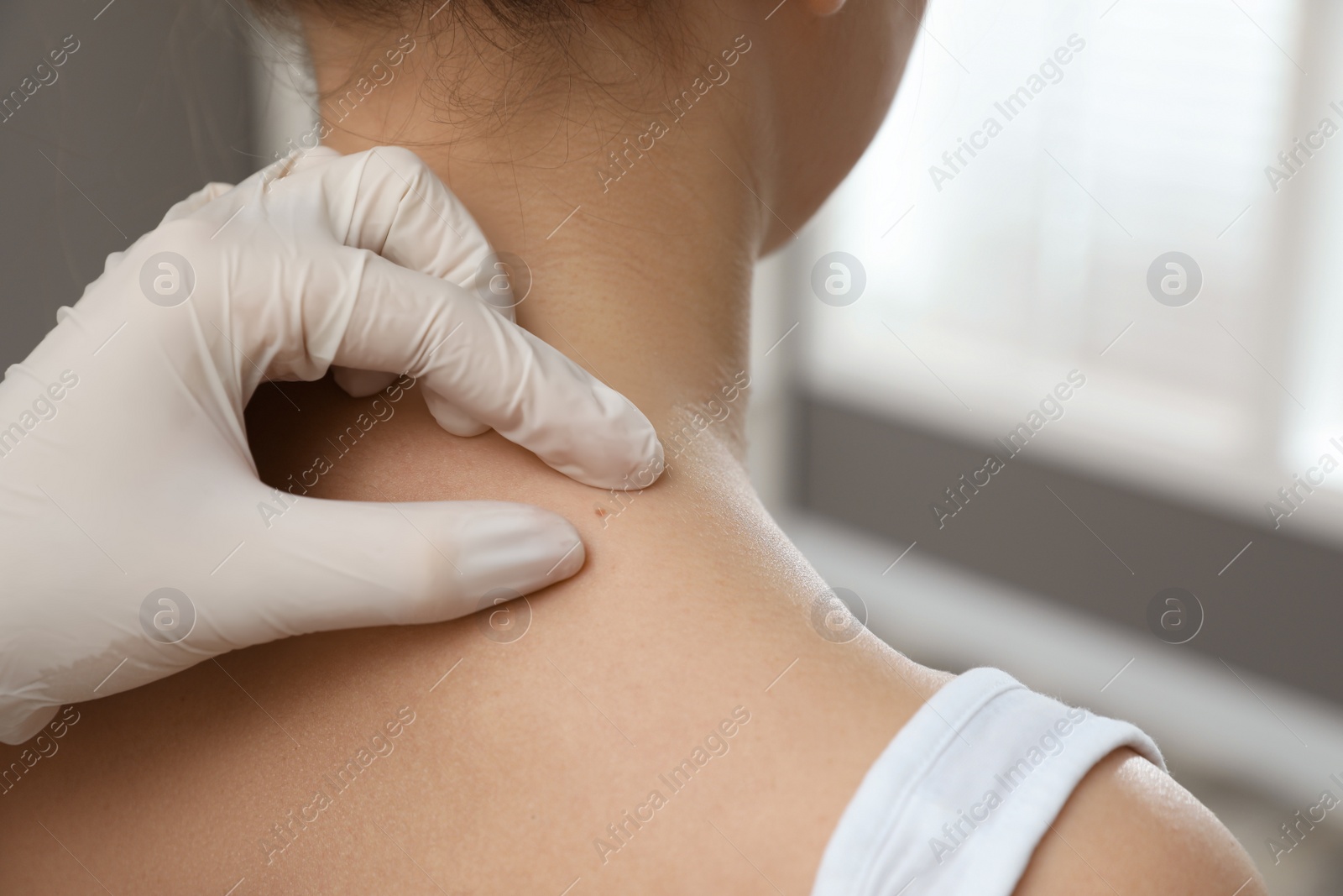 Photo of Dermatologist examining patient's birthmark in clinic, closeup view