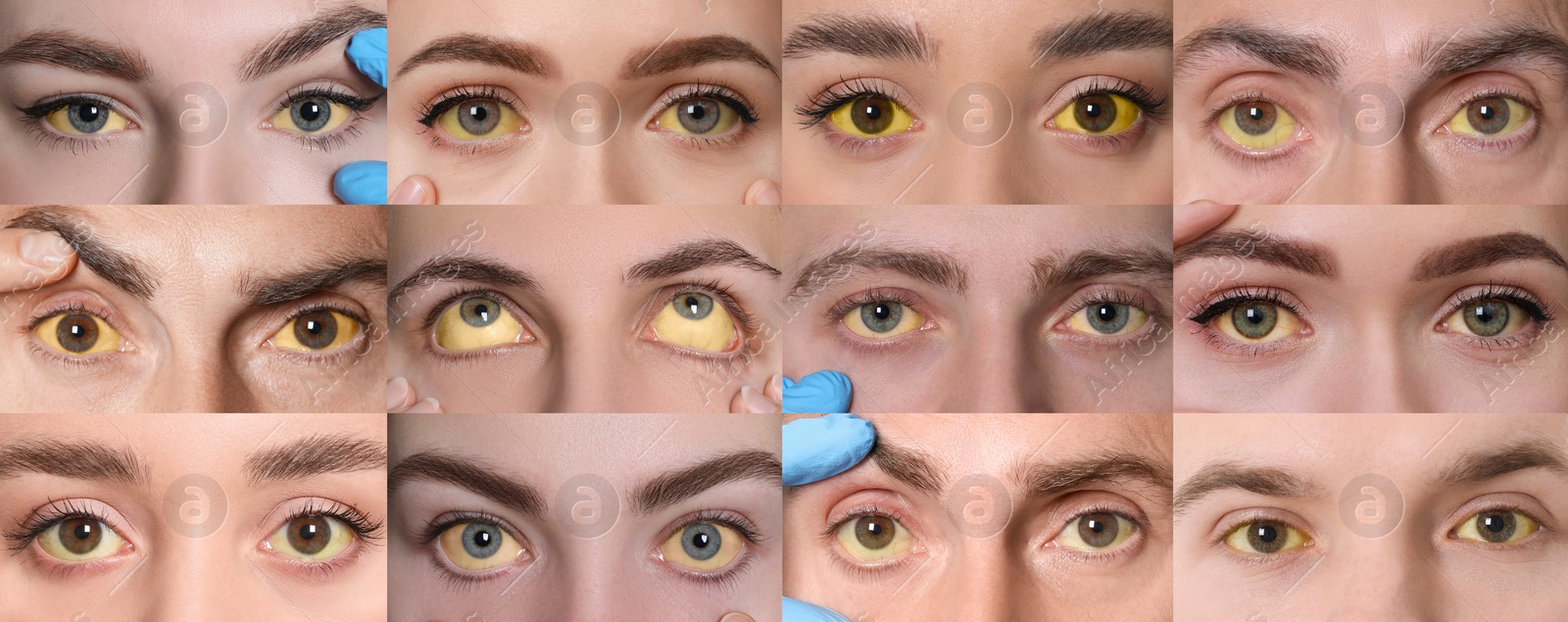 Image of Yellowing of eyes as symptom of hepatitis. Collage with photos of people