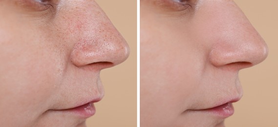 Image of Blackhead treatment, before and after. Collage with photos of woman on beige background, closeup view