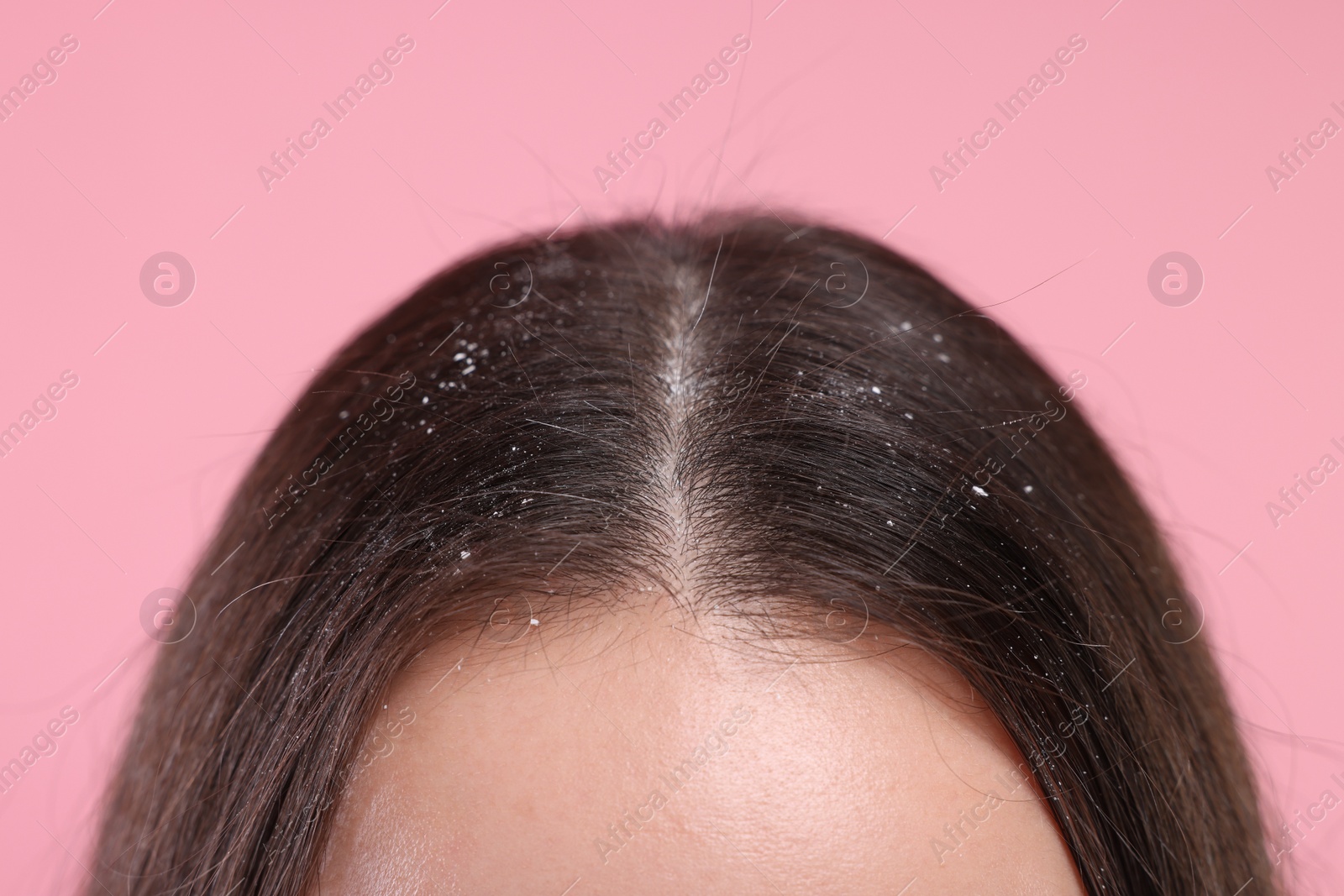 Photo of Woman with dandruff problem on pink background, closeup