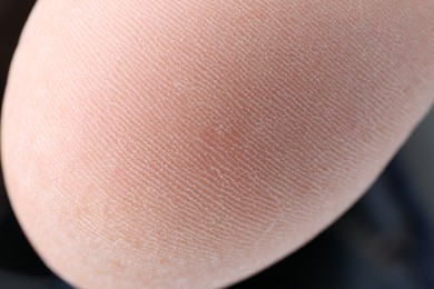 Photo of Woman with dry skin on foot, closeup