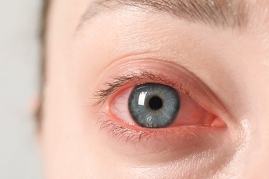 Woman with red eye suffering from conjunctivitis on light background, closeup