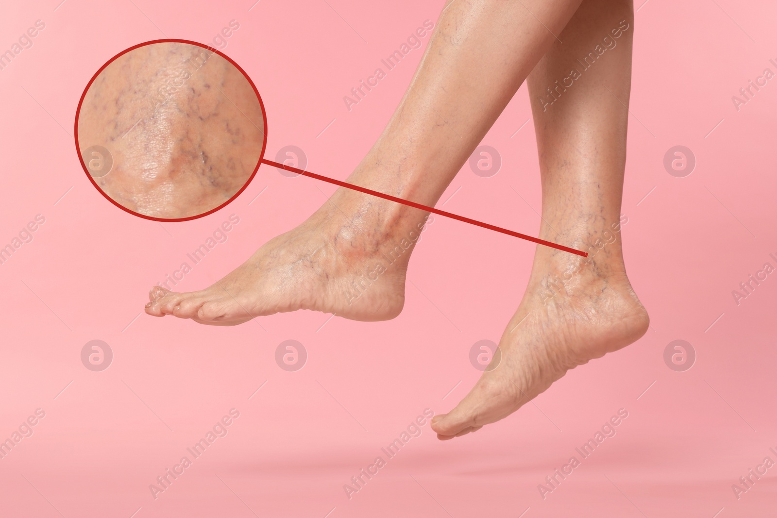 Image of Woman suffering from varicose veins on pink background, closeup. Magnified skin surface showing affected area