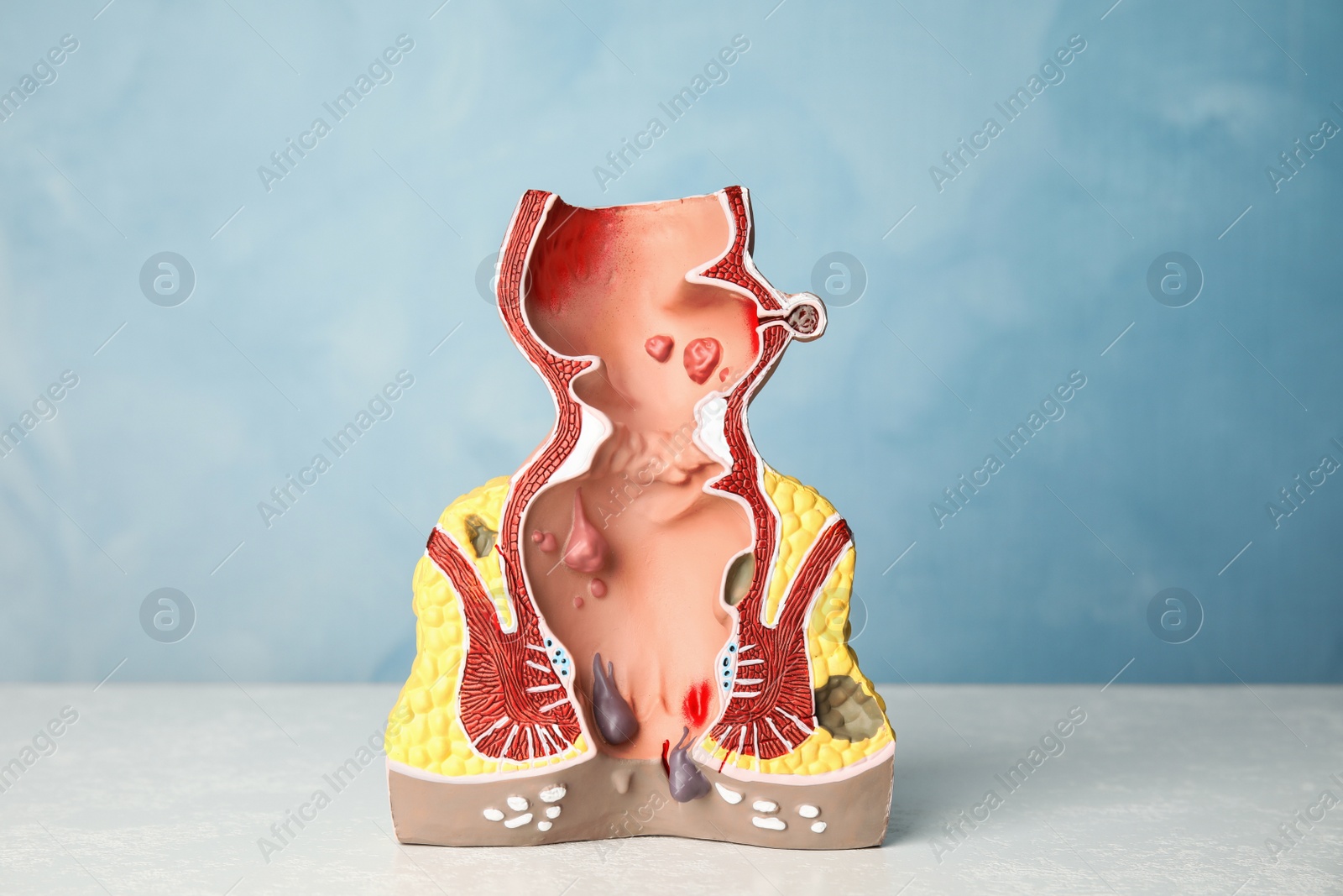 Photo of Model of unhealthy lower rectum with inflamed vascular structures on white table. Hemorrhoid problem