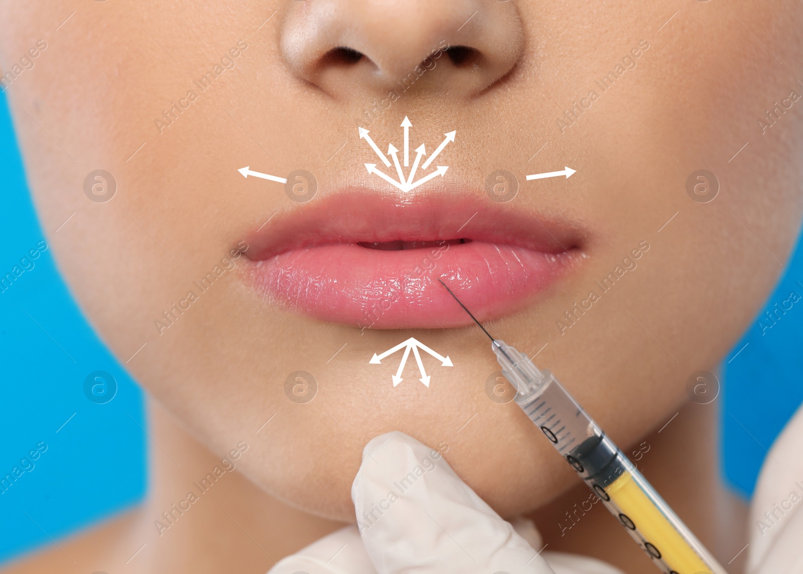 Image of Young woman getting lips injection, closeup. Cosmetic surgery