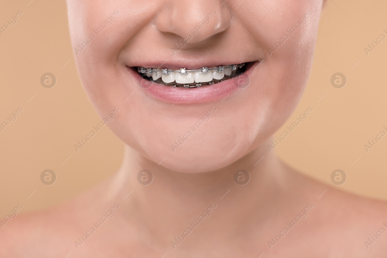 Photo of Smiling woman with dental braces on beige background, closeup