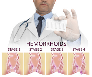 Image of Doctor holding suppositories for hemorrhoid treatment over illustration of lower rectum progressing disease
