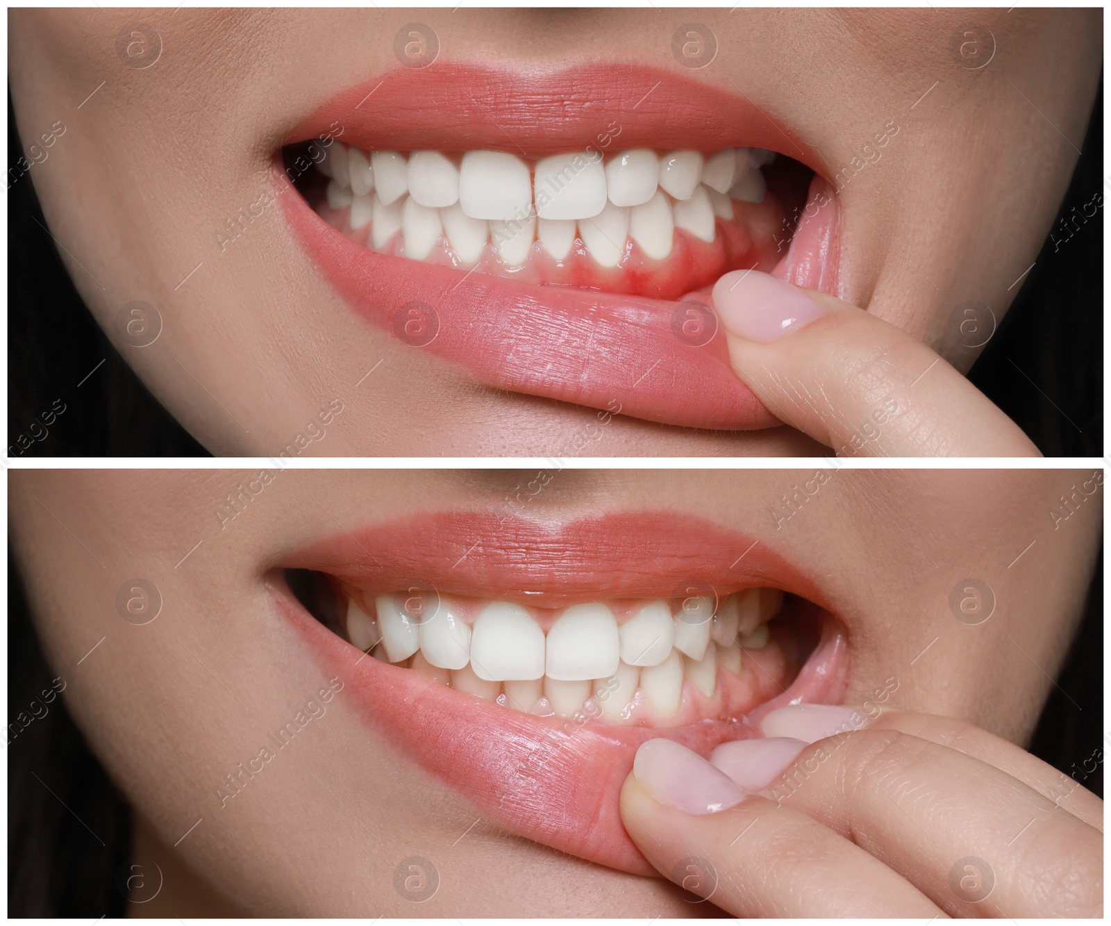 Image of Woman showing gum before and after treatment, collage of photos