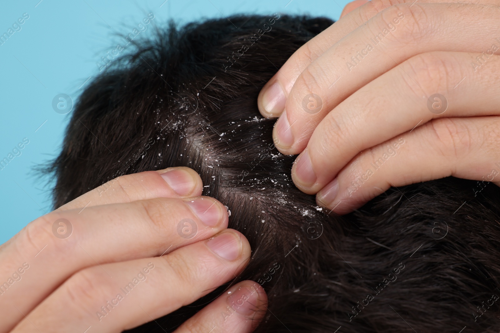 Photo of Man with dandruff in his dark hair on light blue background, closeup