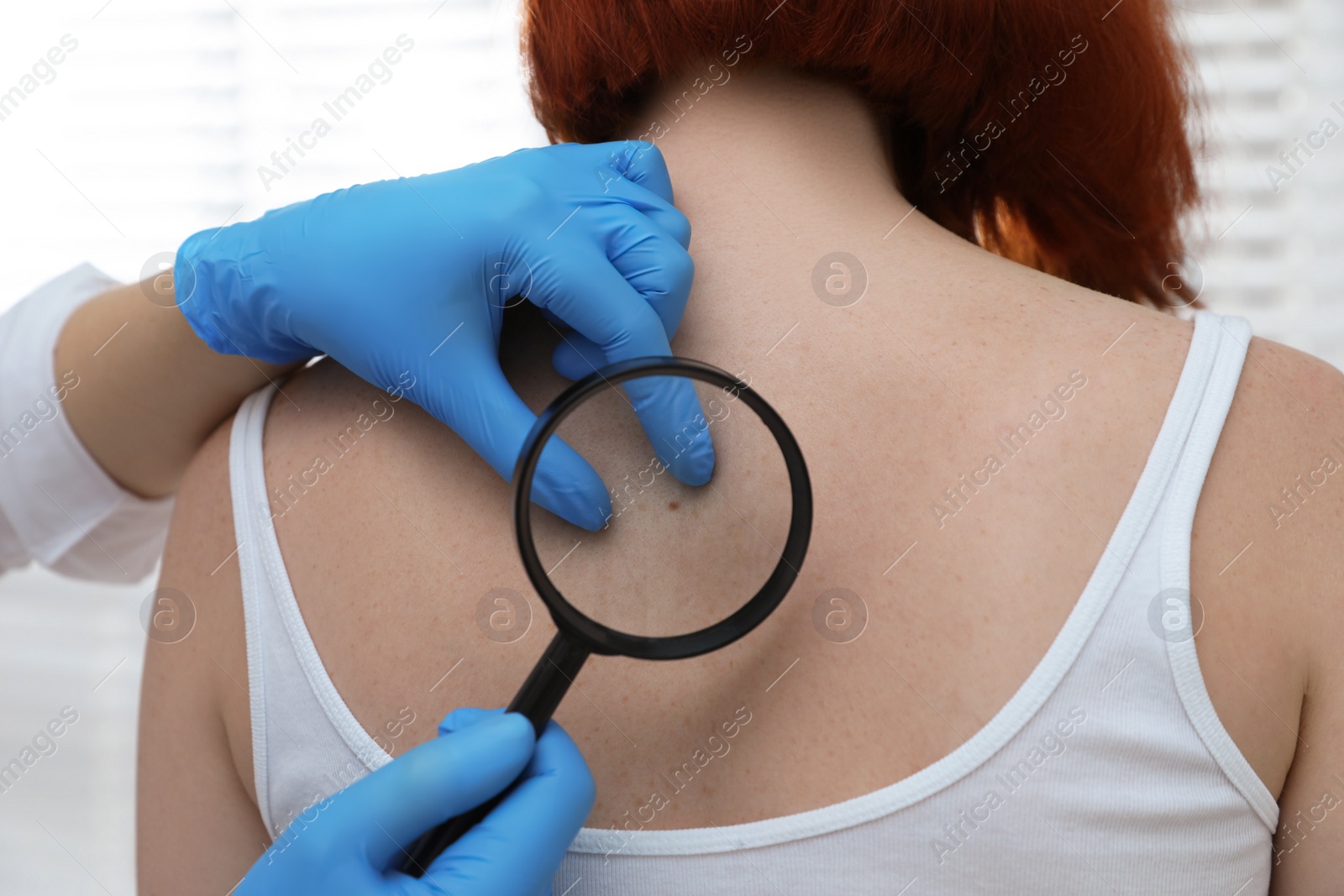 Photo of Dermatologist examining patient's birthmark with magnifying glass in clinic, closeup view