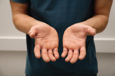 Photo of Man suffering from calluses on hands indoors, closeup