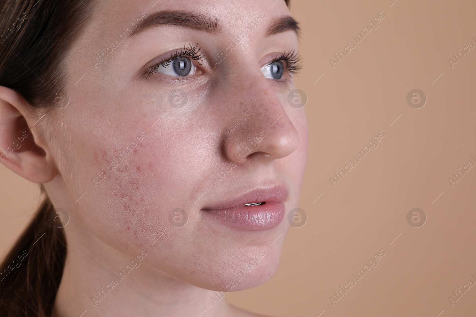 Photo of Young woman with acne problem on beige background, closeup. Space for text