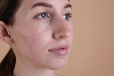 Young woman with acne problem on beige background, closeup. Space for text