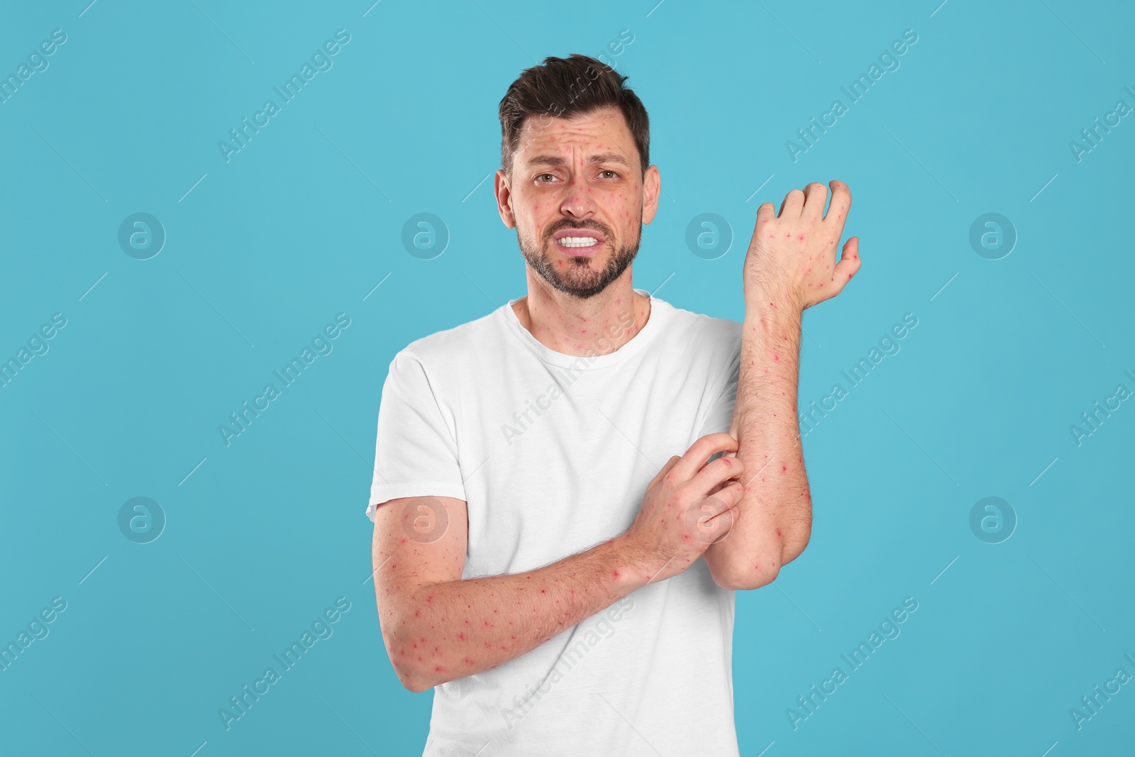 Photo of Man with rash suffering from monkeypox virus on light blue background