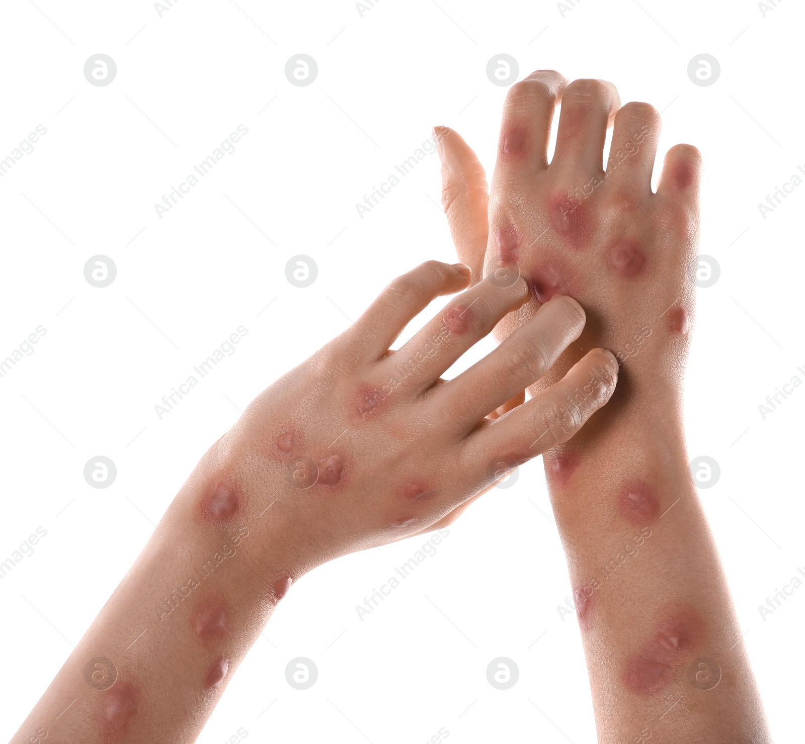 Photo of Woman with rash suffering from monkeypox virus on white background, closeup