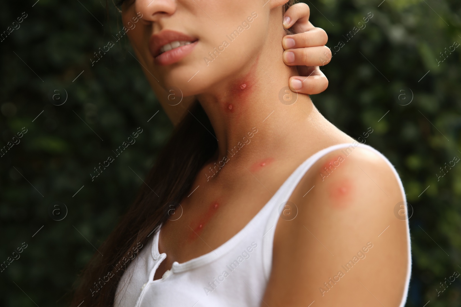 Photo of Woman scratching neck with insect bites in park, closeup