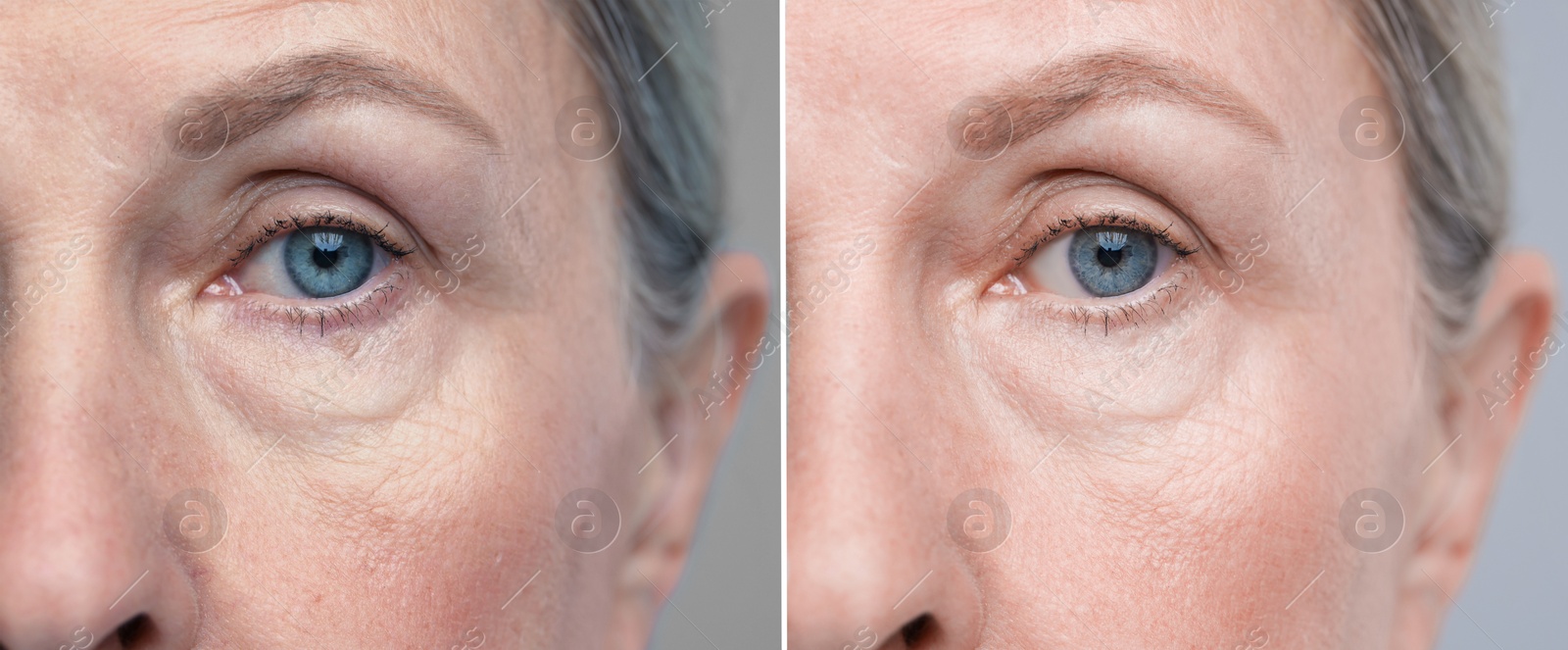 Image of Aging skin changes. Collage with photos of mature woman before and after cosmetic procedure on grey background, closeup