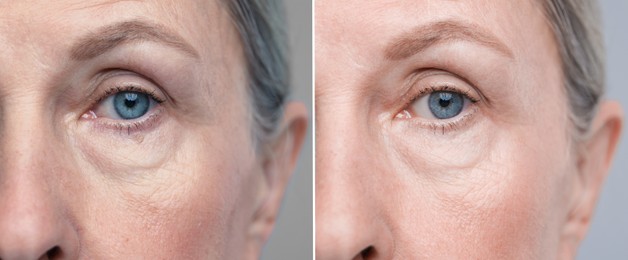 Image of Aging skin changes. Collage with photos of mature woman before and after cosmetic procedure on grey background, closeup