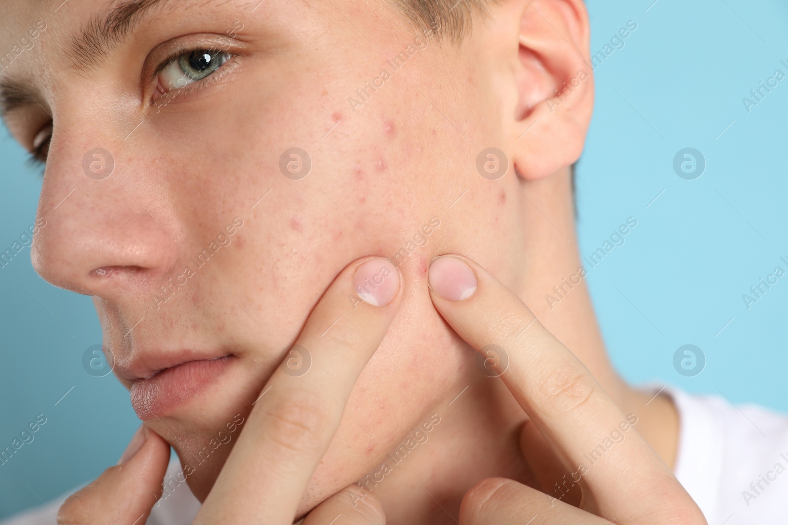 Photo of Teen guy with acne problem squeezing pimple on light blue background, closeup