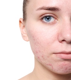 Young woman with acne problem on white background