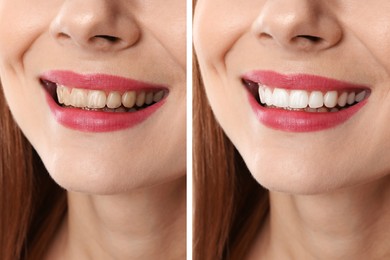 Image of Collage with photos of woman before and after teeth whitening, closeup