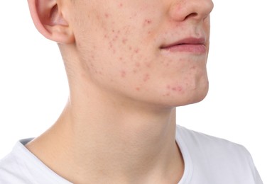 Young man with acne problem isolated on white, closeup