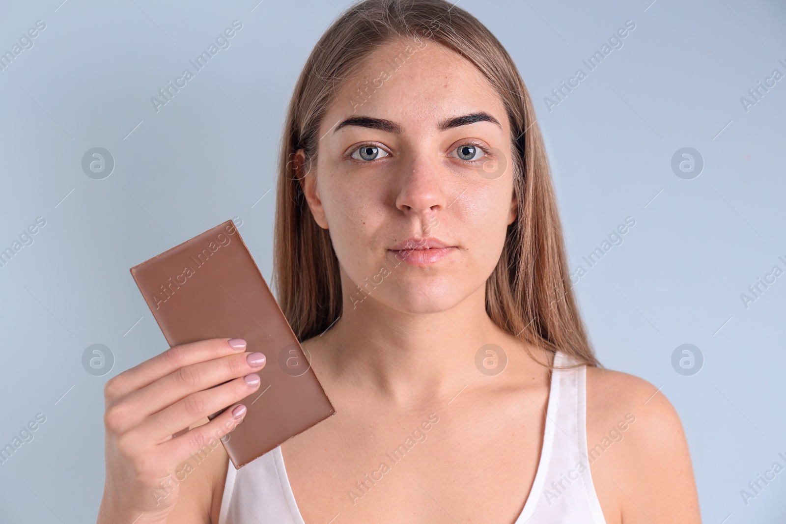 Photo of Young woman with acne problem holding chocolate bar on light background. Skin allergy