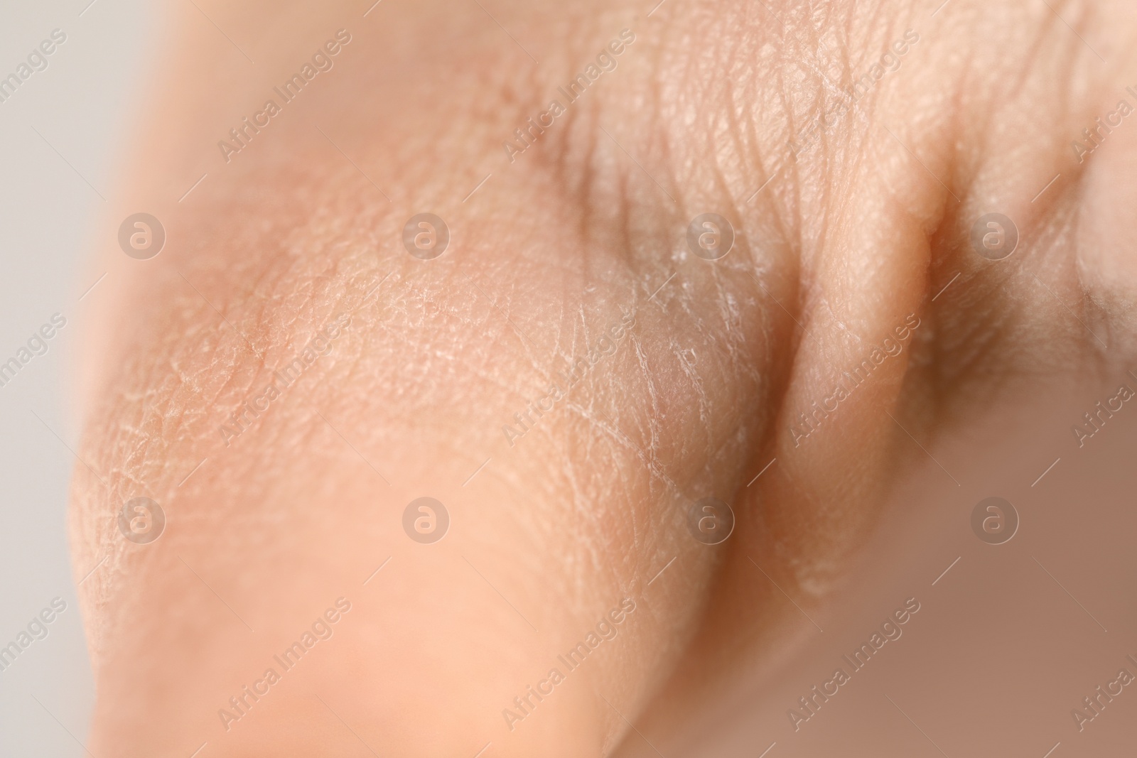 Photo of Little boy with dry skin on hand, closeup