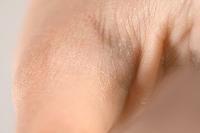 Little boy with dry skin on hand, closeup