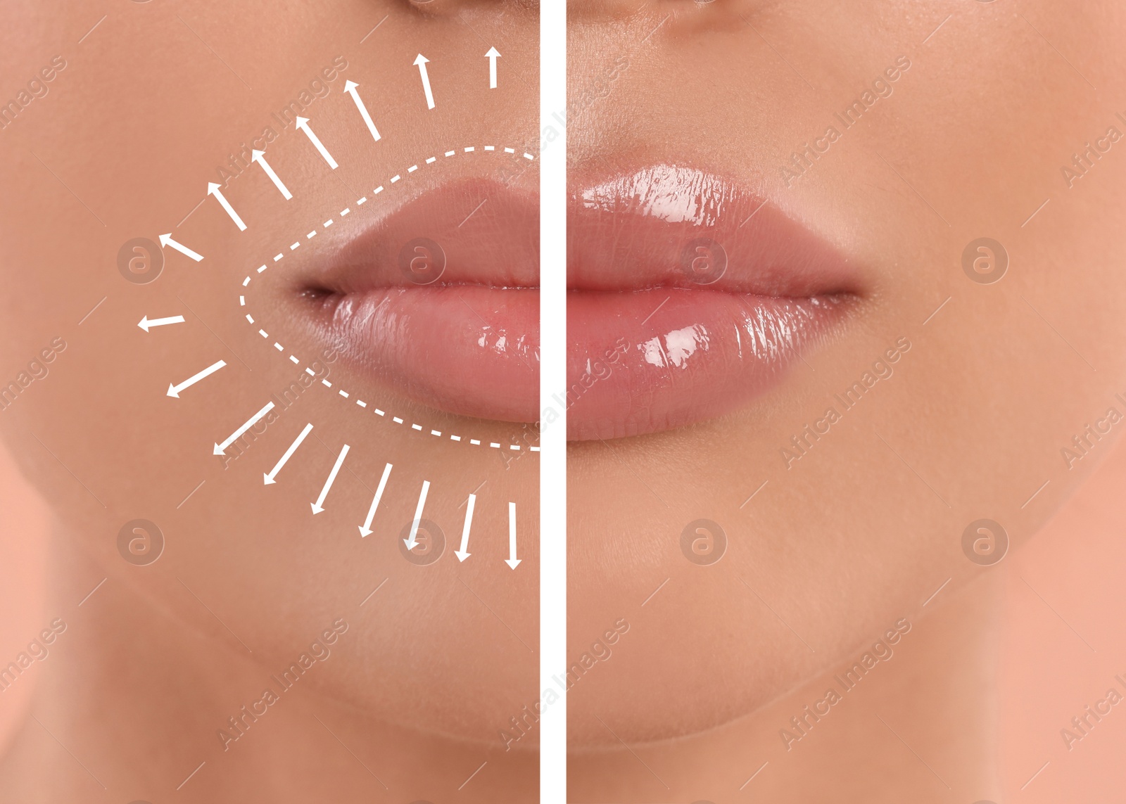 Image of Collage with photos of young woman before and after lips augmentation procedure, closeup