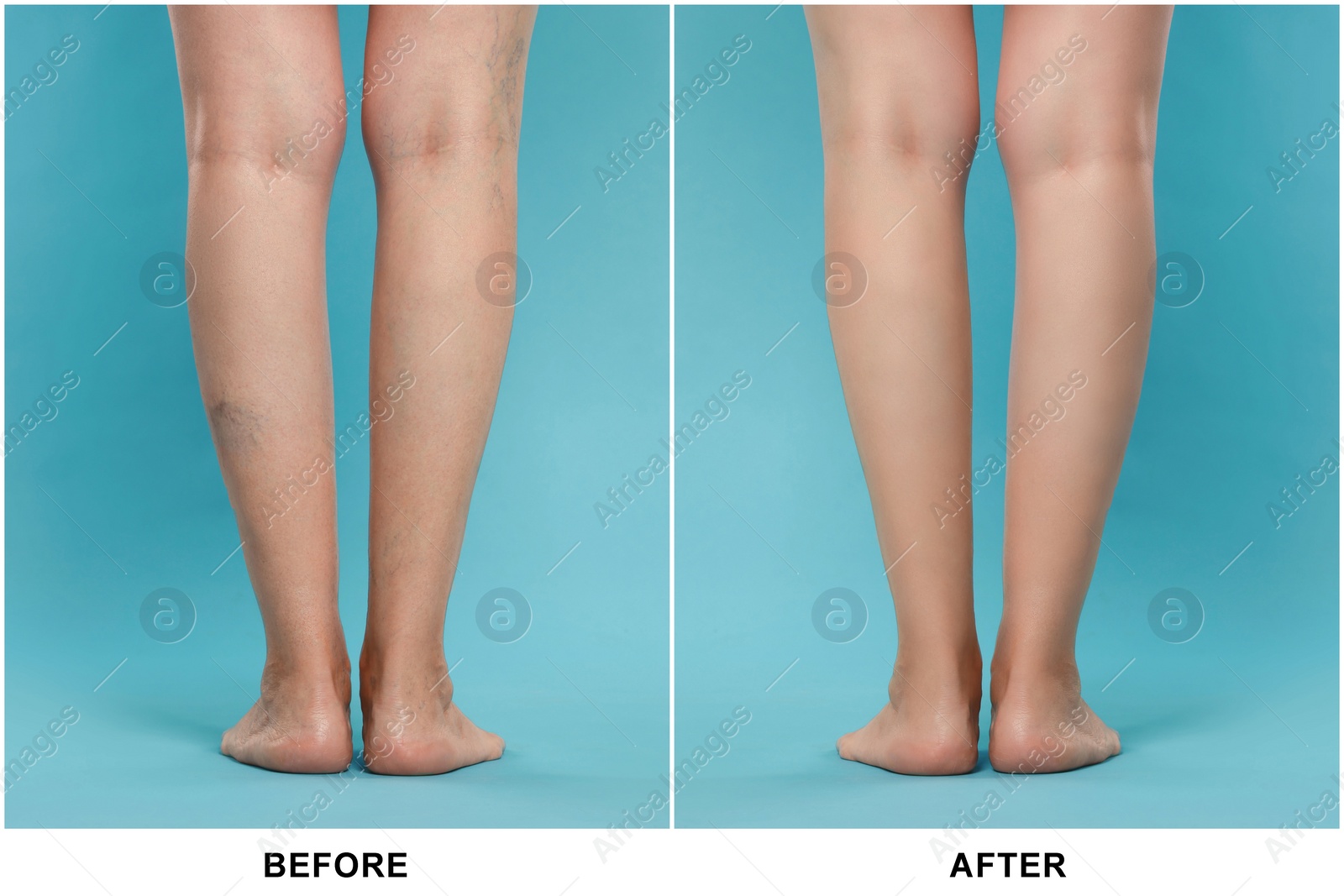 Image of Before and after varicose veins treatment. Collage with photos of woman showing legs on light blue background, closeup