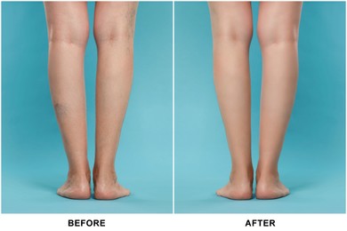 Before and after varicose veins treatment. Collage with photos of woman showing legs on light blue background, closeup